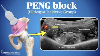 PENG Block Pericapsular Nerve Group Block [upl. by Modesty]