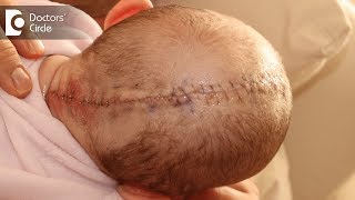 How effective are the results of a Craniosynostosis surgery  Dr Derick Mendonca [upl. by Meryl]