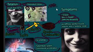 Tetanus Disease Lockjaw  signs and symptoms prevention treatment and prognosis [upl. by Busey]