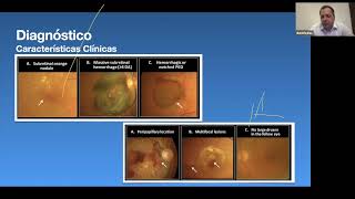 Biomarcadores en Vasculopatía Polipoidea Coroidea [upl. by Amsirp]