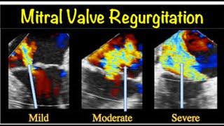 Mitral valve regurgitation  How to Diagnose Mitral Regurgitation [upl. by Asiuol369]