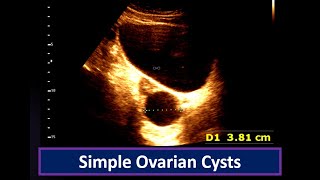 Understanding Simple Ovarian Cysts Ultrasound Findings  Ovarian Cyst  Simple follicular cyst [upl. by Ahtnama]