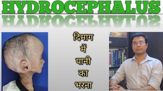 Hydrocephalus A killer disease Hindi  Symptoms amp surgeries  Dr Manish Mishra  Neurosurgeon [upl. by Nihsfa129]