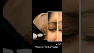 Plasma pen fibroblasts technique for wrinkles and saggy skin plasmapen antiwrinkles saggyskin [upl. by Erastatus]