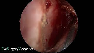 Posteriorly located frontal processlacrimal bone suture line [upl. by Mirabella]