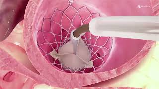 Treatments for Aortic Stenosis [upl. by Robertson]