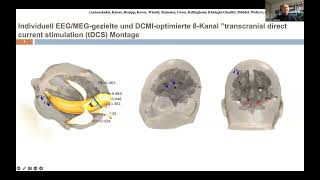 Bioelektromagnetismus Anwendung in d prächirurgischen EpilepsieDiagnose C Wolters Uni Münster [upl. by Tanhya]