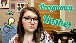 MY PREGNANCY STRUGGLES  PITYRIASIS ROSEA amp PUPPP RASH  STORYTIME [upl. by Audley]