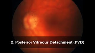 2 Posterior Vitreous Detachment PVD [upl. by Ettennad326]