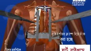 Heart Bypass Surgery Hospitals in India [upl. by Elehcor]