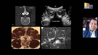 Ultrasound Imaging of the Lumbar Spine Relevant for Neuraxial Blocks Dr Manoj Karmakar Hong Kong [upl. by Heaps]