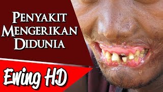 5 Penyakit Mengerikan Didunia [upl. by Nosydam]