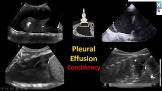 10 cases for Lung Point of care ultrasound Lung POCUS [upl. by Banebrudge]