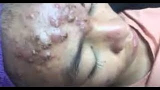 The Most Extreme Blackhead Popping Videos of 2023  satisfying  blackheads  pimple [upl. by Ahsinac324]