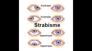 Mon opération du strabisme divergeant exotropie  mon ressenti les jours daprès [upl. by Alleyn]