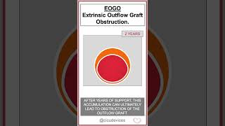 Heartmate LVAD EOGO Extrinsic Outflow Graft Obstruction shorts lvad [upl. by Lind36]