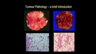 Tumour pathology  a brief introduction part III [upl. by Ibocaj]