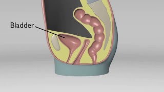 Cystocele No Uterus [upl. by Eerrahs767]