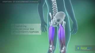 Scheuermann’s kyphosis Symptoms [upl. by Ioyal]