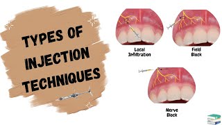 Types of Injections used in Dentistry  Local Anesthesia [upl. by Gnehs928]