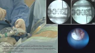 II TELA  Transforaminal Epiduroscopic Laser Annuloplasty   full procedure [upl. by Marsha526]