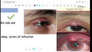 Eyelid Diseases OPH [upl. by Baptist152]