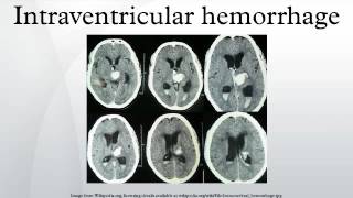 Intraventricular hemorrhage [upl. by Etterrag]