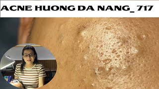 Acne Treatment Huong Da Nang 717  Remove Blackheads [upl. by Abert775]