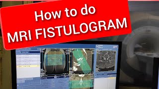 Fistulogram MRI scan protocol positioning and planning [upl. by Crowns226]