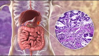 Hypoxia induces neutrophil extracellular trap formation to drive gastric cancer growth [upl. by Werra]