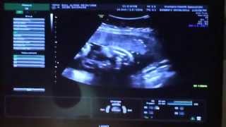 34 weeks and 3 days pregnant ultrasound [upl. by Arehahs]