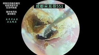 采耳哥Thick and dry slices of external auditory meatusearwax asmr drzhao ｜551 [upl. by Vala940]