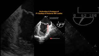 Prolapse of P1 scallop of Posterior Mitral Valve Leaflet echocardiography cardiology doctor [upl. by Windsor]