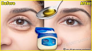 In 3 days Remove Under Eye Bags Completely  Remove Dark Circle Wrinkles Puffy Eyes [upl. by Ydoow]