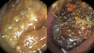 145  Masses of Ear Wax Removed from Interior amp Anterior Recess of Bendy Ear using WAXscope®️ [upl. by Najar765]