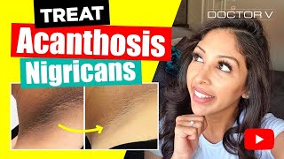 Doctor V  How To Treat Acanthosis Nigrican  Skin Of Colour  Brown Or Black Skin [upl. by Rehtaef]