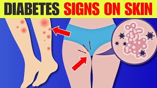 8 Diabetes Signs on Skin  Beware‼️ [upl. by Lebazi]