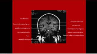 Brain Herniation imaging [upl. by Arema]