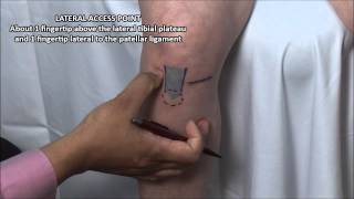 Knee Injection  Anterior Approach [upl. by Ayomat]