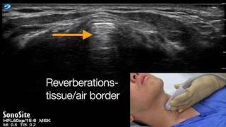 Cricothyroid membrane identification with ultrasound  transverse approach [upl. by Silma]