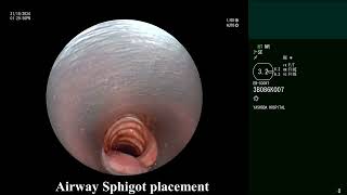 Hemoptysis Bronchoscopic endobronchial sphigot  Watanabe  placement with Glue instillation [upl. by Notelrahc224]