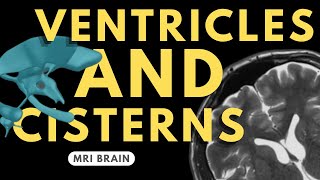 Ventricles and Cisterns of the Brain  Radiology anatomy part 1 prep  MRI brain [upl. by Doran]