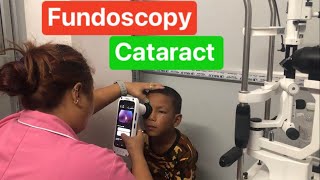 Fundoscopy  Retina  Congenital Cataract [upl. by Iverson]