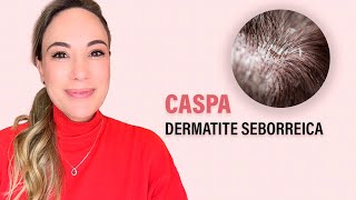 Dermatite Seborreica  a tão temida CASPA [upl. by Cayla]