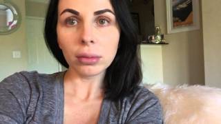 My Botox Experience amp Review Before amp After  stasisafari [upl. by Yerok]