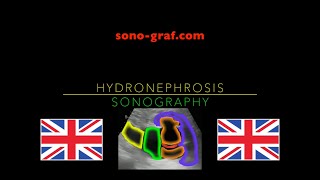 Sonography  Hydronephrosis [upl. by Jillie]