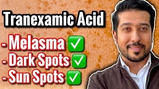 3 BEST Tranexamic Acids for Melasma and Discoloration not sponsored [upl. by Maitund]