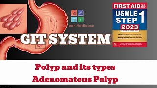 USMLE Step1 Polyp and its types Adenomatous Polyps from first aid step 1USMLEUrduHindi [upl. by Grearson]