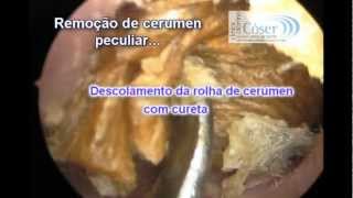 The Biggest Earwax removal by otoendoscopic technique everA Maior cera de ouvido do mundo [upl. by Eimas630]