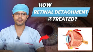 How Retinal Detachment Treated  Retinal Detachment Signs Symptoms amp Treatments [upl. by Ahsimak768]